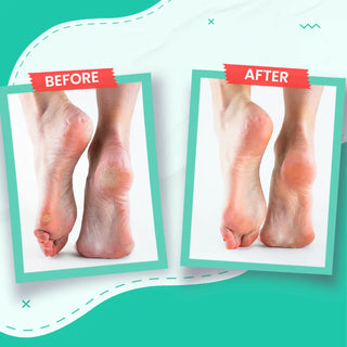 Foot Cream - For Dry & Cracked Skin